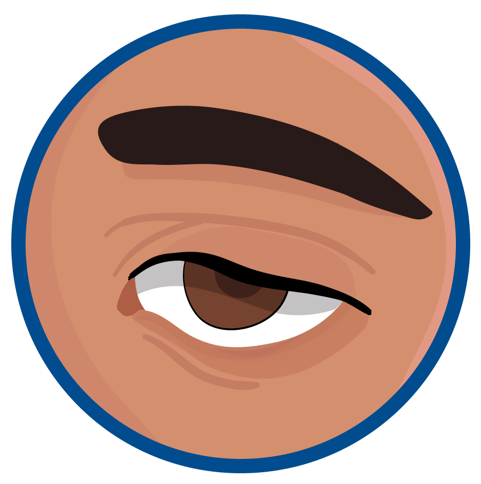 Síntomas de la mielitis flácida aguda: dificultad para mover los ojos o párpados caídos.