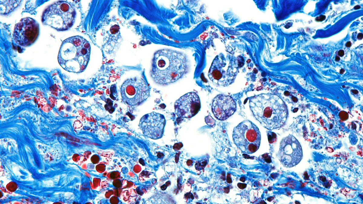 High resolution of Entamoeba histolytica parasite in a person's small intestine.