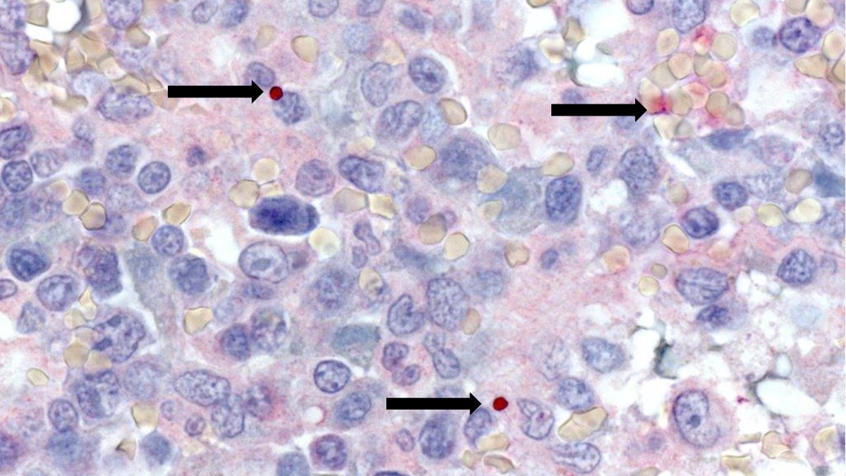 Immunohistochemical stain demonstrating Anaplasma phagocytophilum morulae in the spleen of a patient with splenic rupture associated with anaplasmosis.