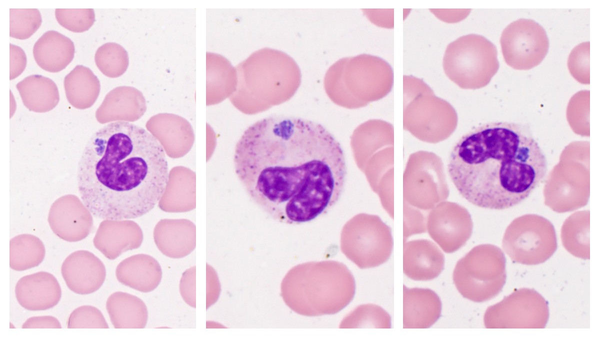 Peripheral blood smear from a patient with anaplasmosis showing morulae in granulocytes.