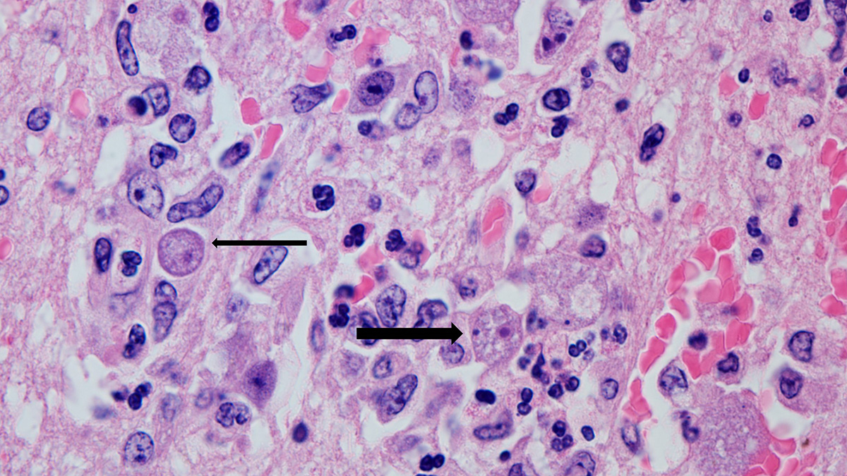 Balamuthia amebas in a human brain. Thick arrow points to infectious form. Thin arrow points to noninfectious form.