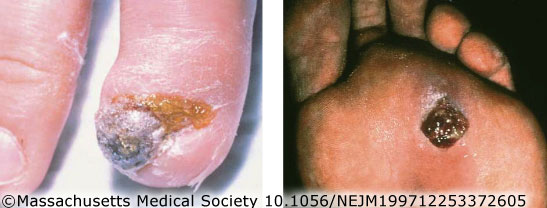 CSD_101056_NEJM199712253372605.jpg Bacillary angiomatosis on fingers and toes.