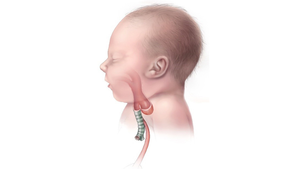 esophageal atresia Ilustración de un bebé con atresia esofágica de tipo C.