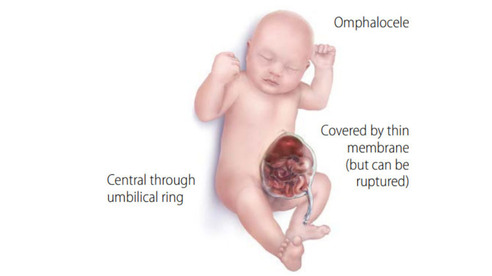 Labeled Illustration Omphalocele Illustration of infant with omphalocele. Text on the graphic reads omphalocele, central through the umbilical cord, covered by a thick membrane (but can be ruptured).
