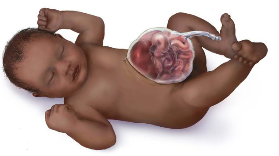 Plain Omphalocele Ilustración de un bebé con onfalocele.
