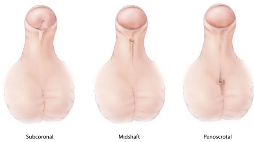 Ilustración médica del hipospadias que muestra los 3 tipos: subcoronal (la abertura de la uretra se sitúa cerca de la cabeza del pene), peneano (la abertura de la uretra se sitúa en el cuerpo del pene) penoescrotal (la abertura de la uretra se sitúa donde se unen el pene y el escroto).