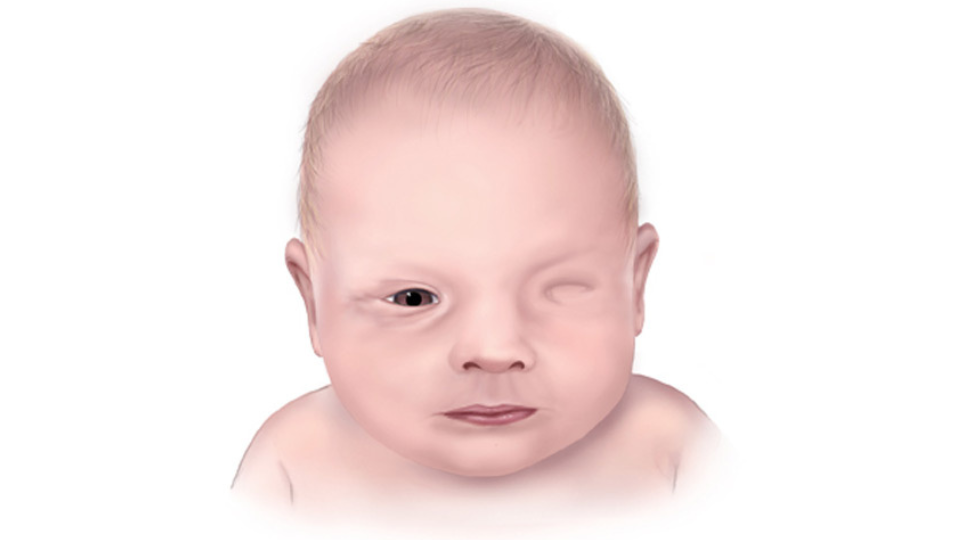 Anophthalmia Ilustración de un bebé al que le falta un ojo a causa de la anoftalmía.