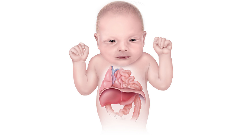 Illustration of infant with diaphragmatic hernia Illustration of infant showing internal organs. Infant has diaphragmatic hernia, and abdominal organs are in chest.