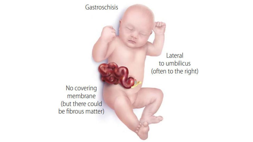 -- title missing -- Ilustración médica de un bebé con gastrosquisis.