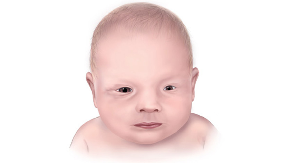 Microphthalmia Ilustración de un bebé con un ojo pequeño a causa de la microftalmia.
