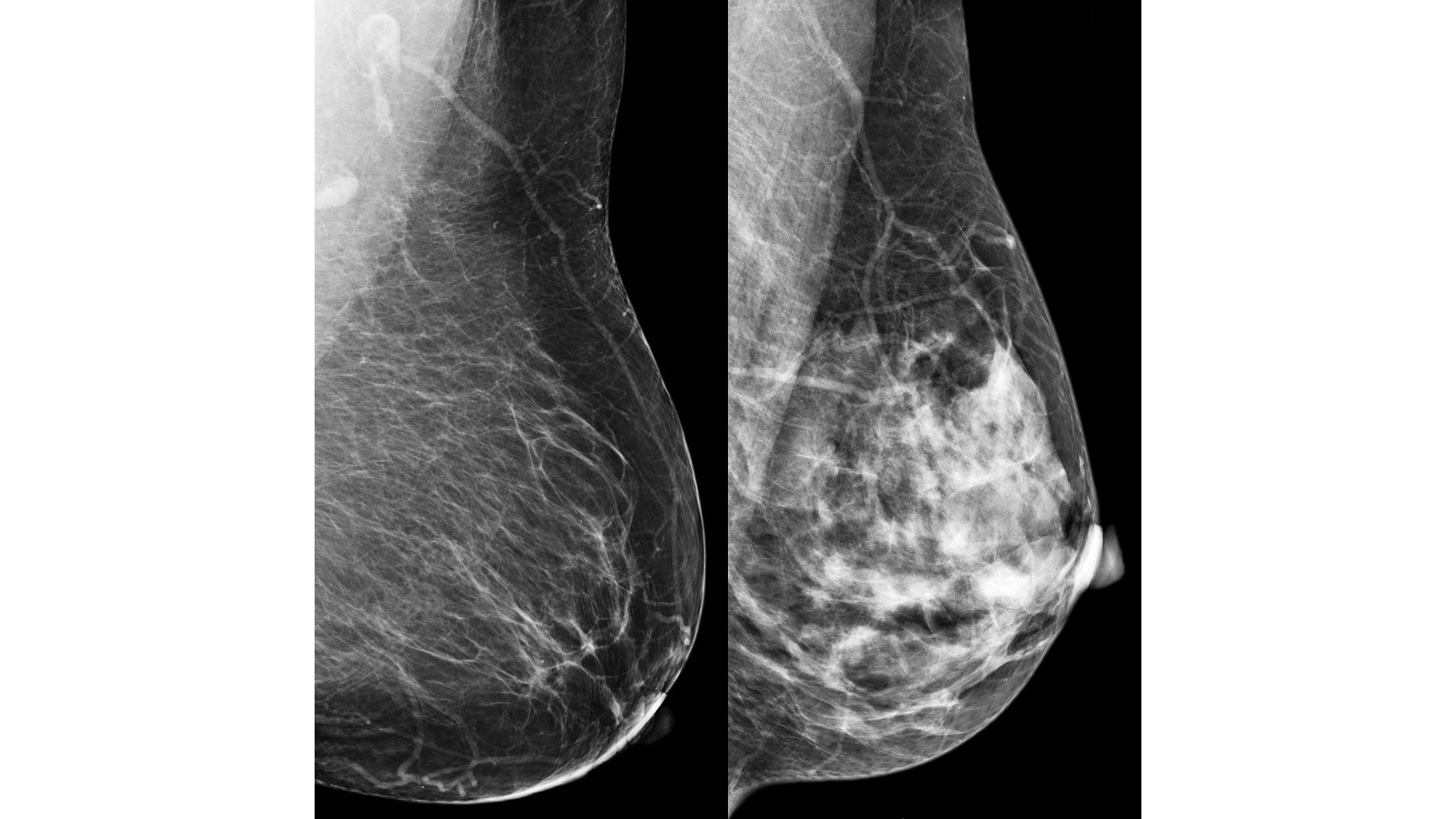 Two Mammograms Two mammograms showing a fatty breast and a dense breast