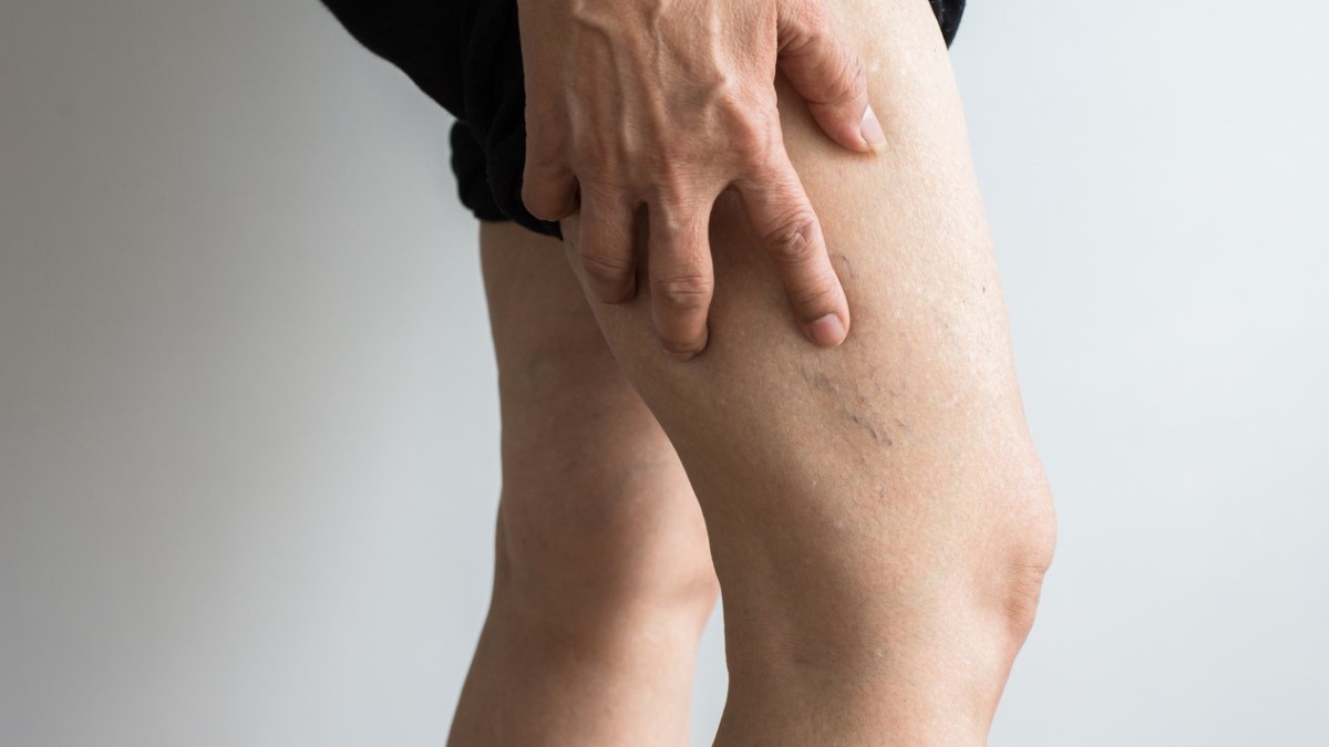 a person with a blood clot in the leg