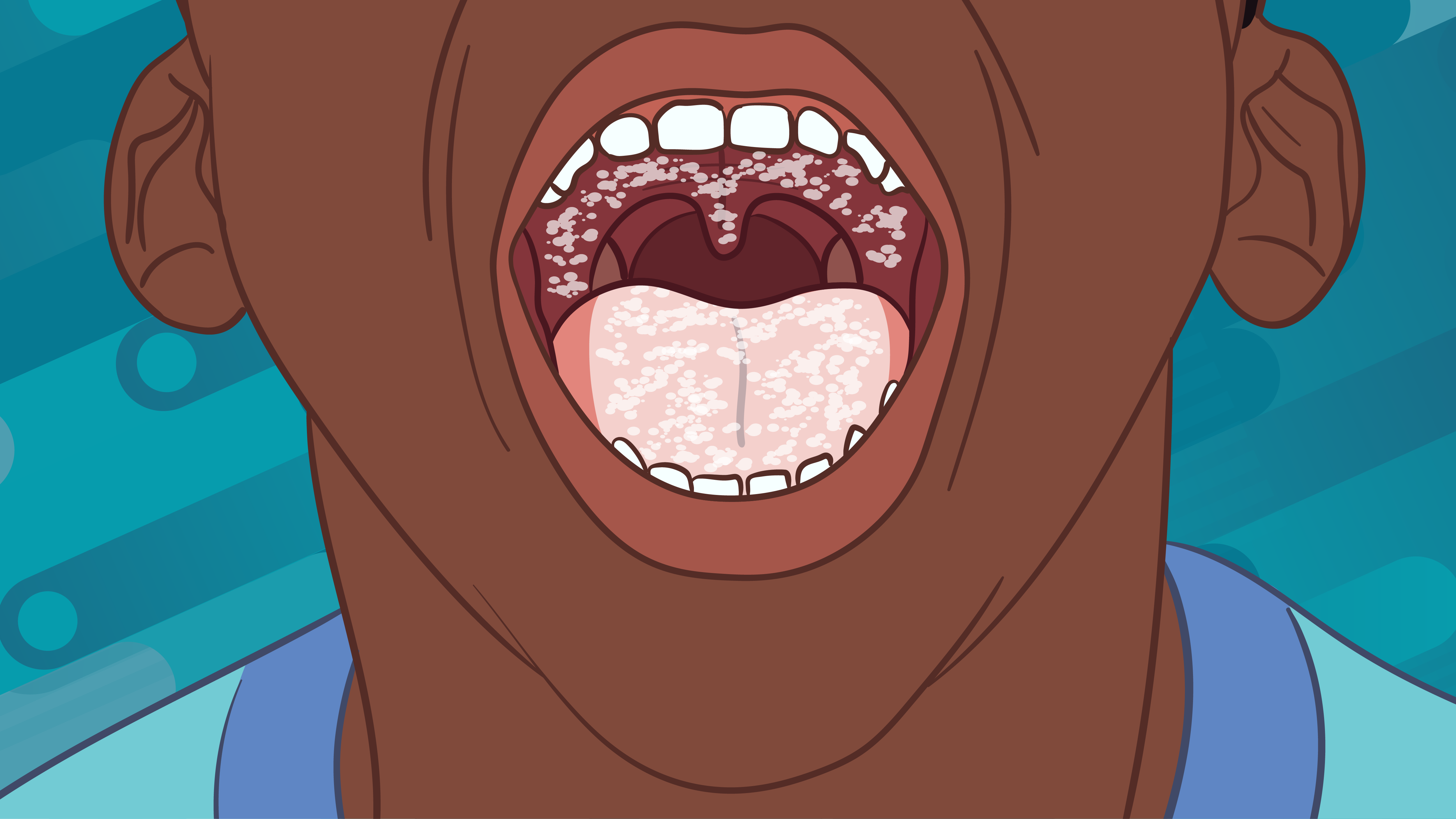 Candidiasis in the throat Candidiasis in the mouth