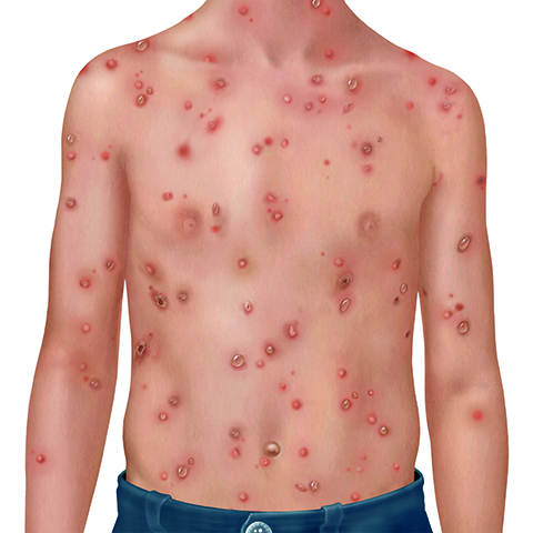varicella rash