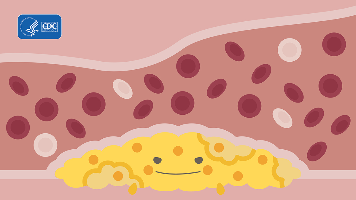 A cholesterol monster.