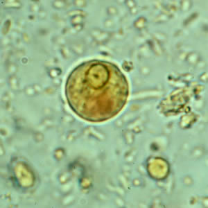 Ehistdisp_cyst_wtmt.jpg