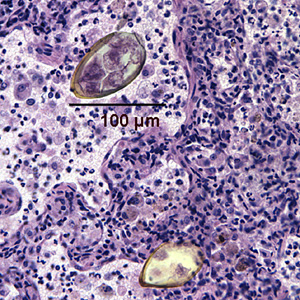Paragonimus_egg_lung_biopsy1.jpg