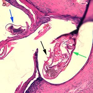 scabies_tissue_BAM2.jpg