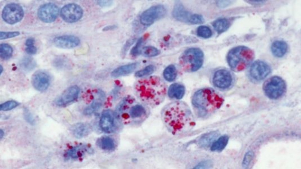 Immunohistochemical stain demonstrating E. chaffeensis morulae within the kidney of a patient with ehrlichiosis.
