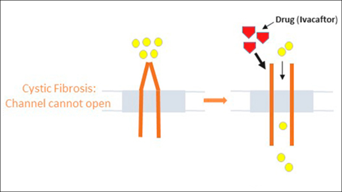 Closed channel In some cases of cystic fibrosis, the channel is present but cannot open. The drug ivacaftor acts to open the channel.