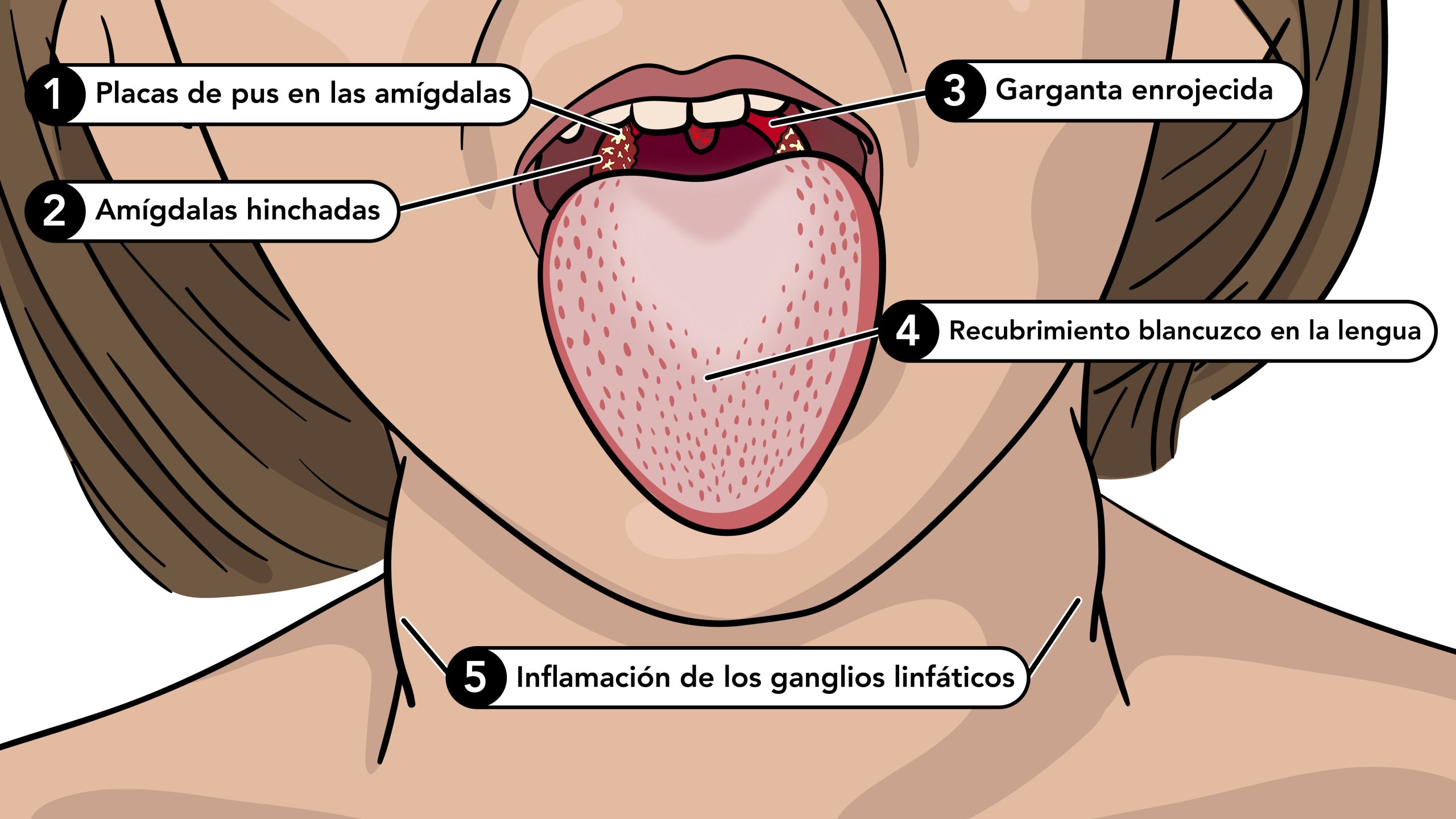 336119_scarlet_fever_white_tongue_labels_es.jpg Los síntomas de la escarlatina incluyen lengua blanca, garganta roja, amigdalas hinchadas y ganglios linfáticos inflamados.