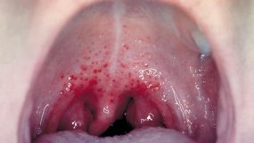 — title missing — Patient exhibiting redness and edema of the oropharynx, and petechiae.