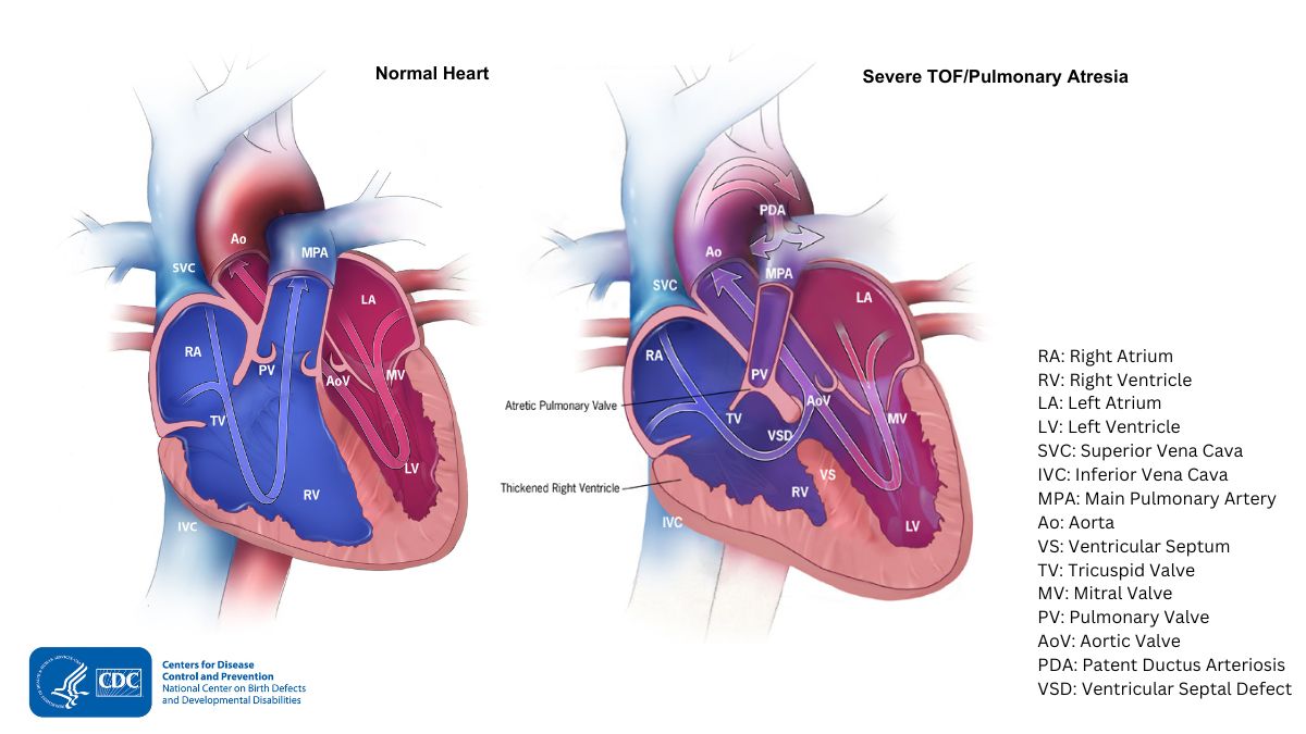 Diagram showing heart with severe TOF/pulmonary atresia and a normal heart Diagram showing heart with severe TOF/pulmonary atresia and a normal heart
