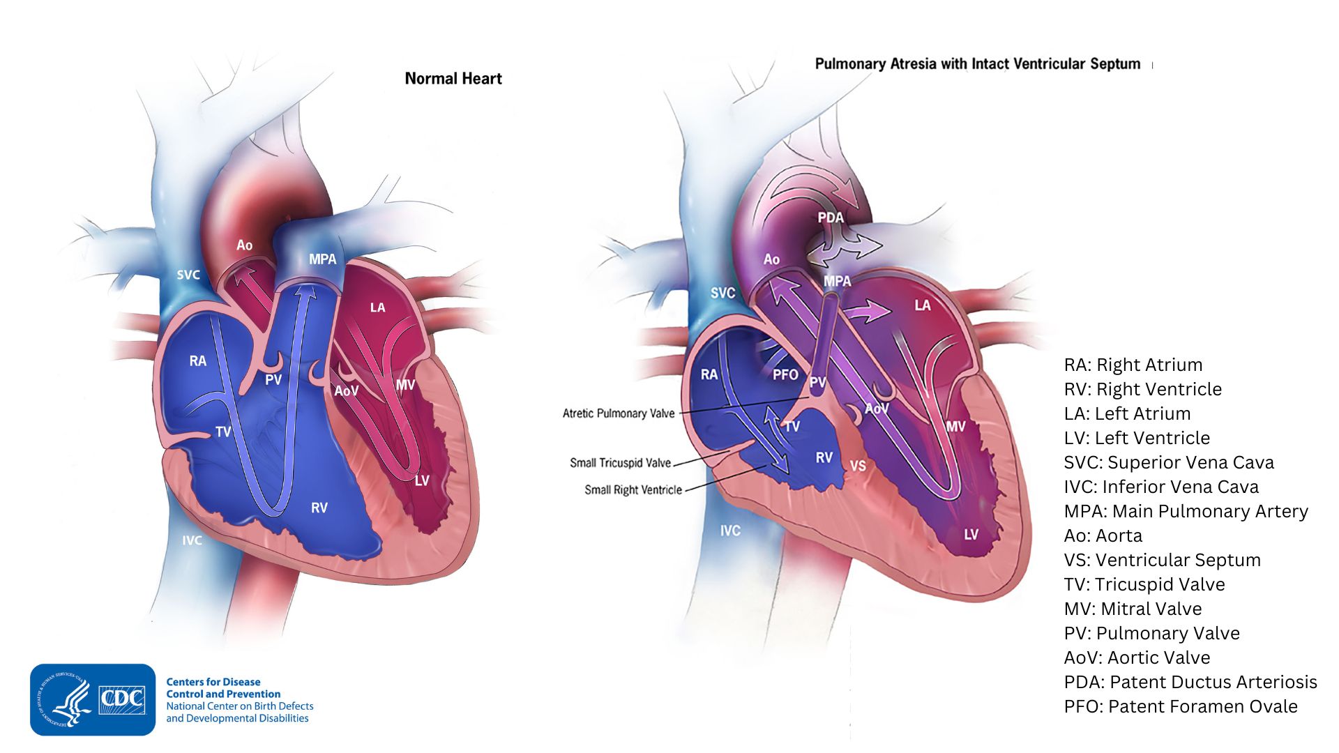 Diagram showing heart with pulmonary atresia and a normal heart Diagram showing heart with pulmonary atresia and a normal heart