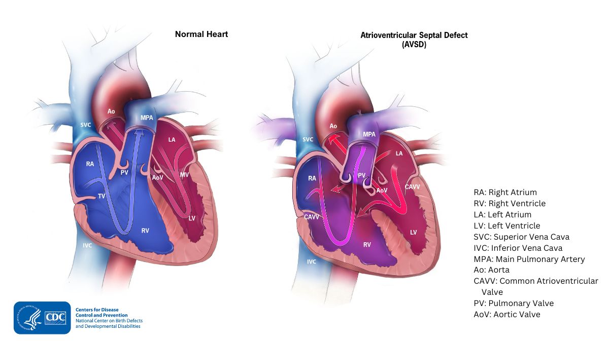 Diagram showing atrioventricular septal defect and normal heart Diagram showing atrioventricular septal defect and normal heart