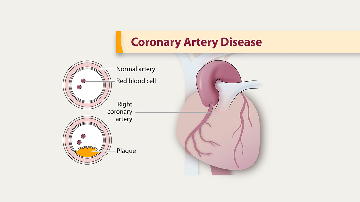 coronary-artery-disease Illustration of coronary artery disease showing plaque build up in the arteries.