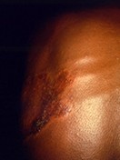 A red skin lesion and enlarged nerves on a person's chest