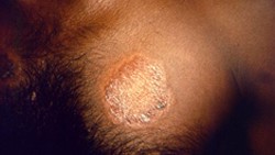 A light-colored skin lesion on someone's chest