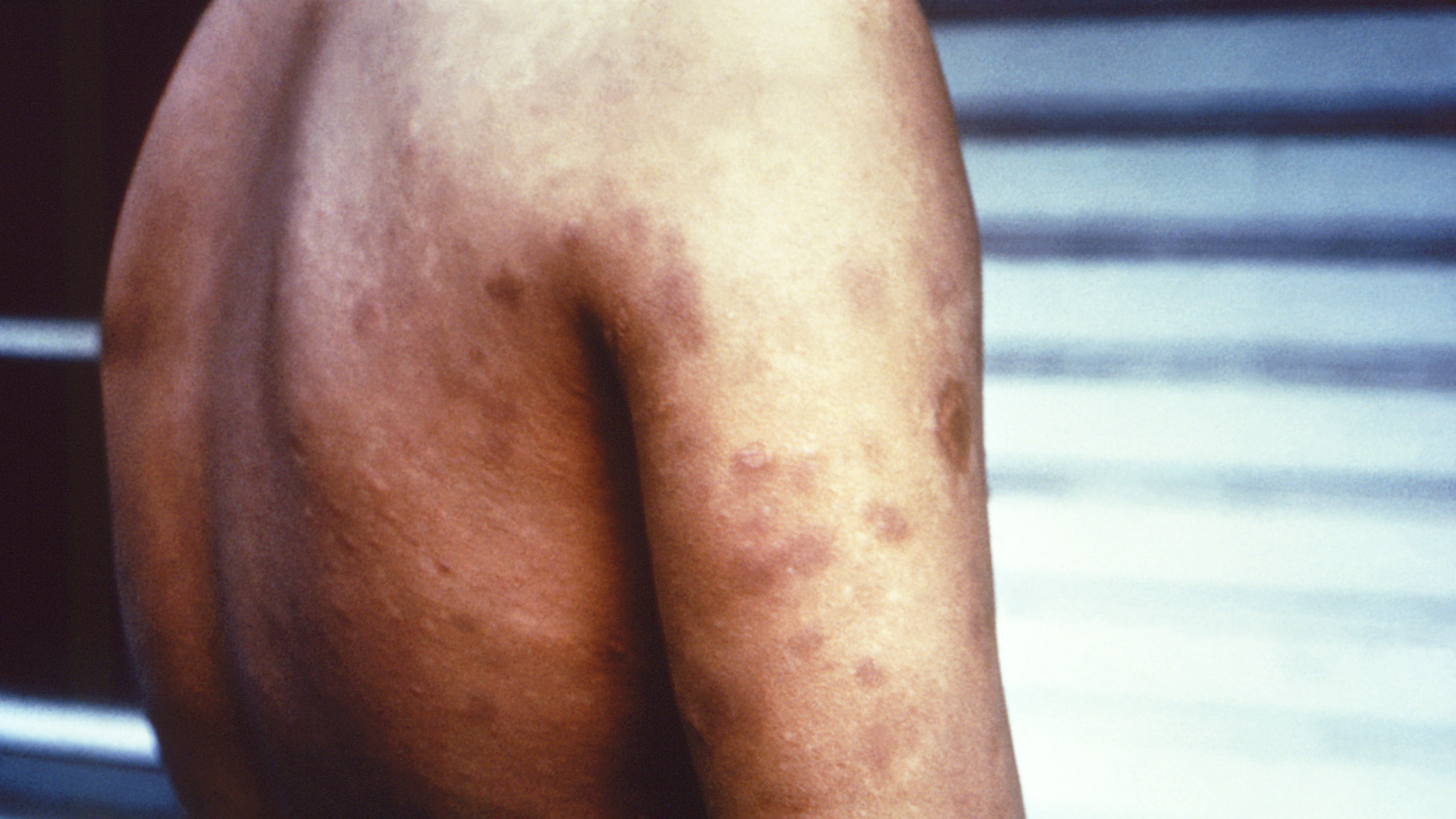 Hansen's disease lesions on a person's back and arms