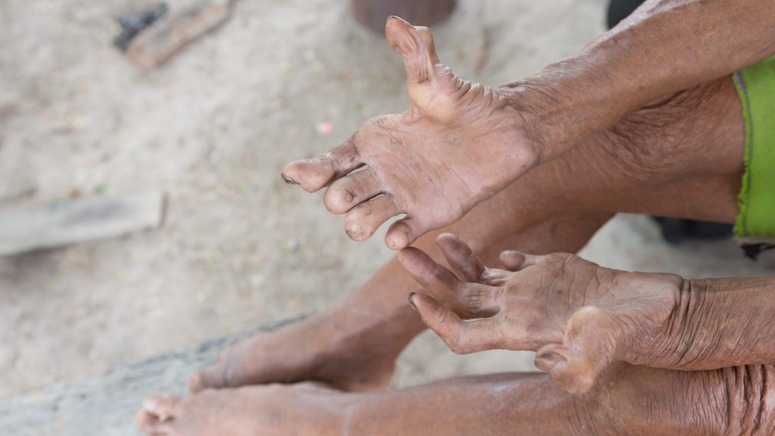 A person with untreated Hansen's disease shows their hands and feet.
