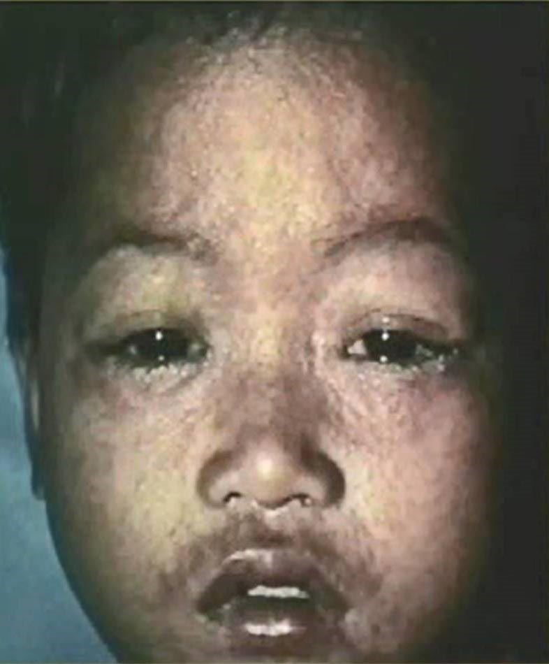 Niño pequeño, de piel oscura, con ojos llorosos, moqueo y sarpullido elevado.