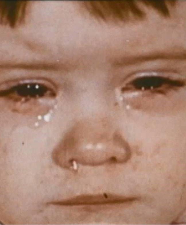 Niño pequeño con enfermedad moderada: moqueo y ojos llorosos causados por la infección por el virus del sarampión.