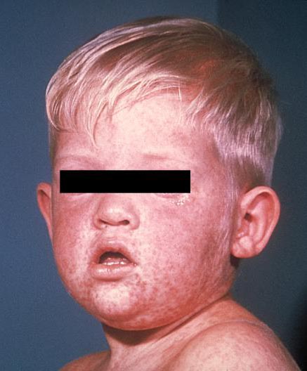 Cara de un niño con sarampión (sarpullido de tres días).