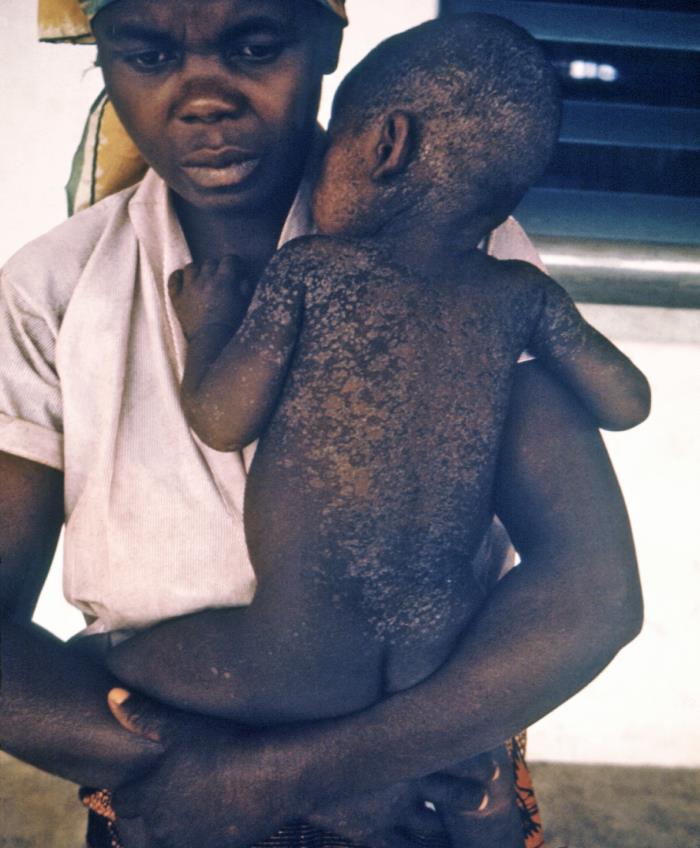 Esta fotografía de fines de la década de 1960 muestra a una madre nigeriana y a su hijo que se está recuperando del sarampión; notar que la piel del niño se está descamando a medida que se cura de su infección por el virus del sarampión.
