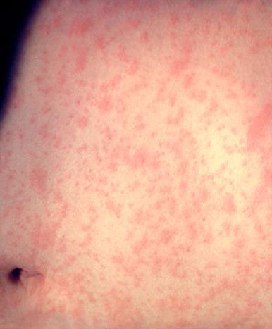 Esta es la piel de un paciente después de 3 días con la infección por el virus del sarampión.