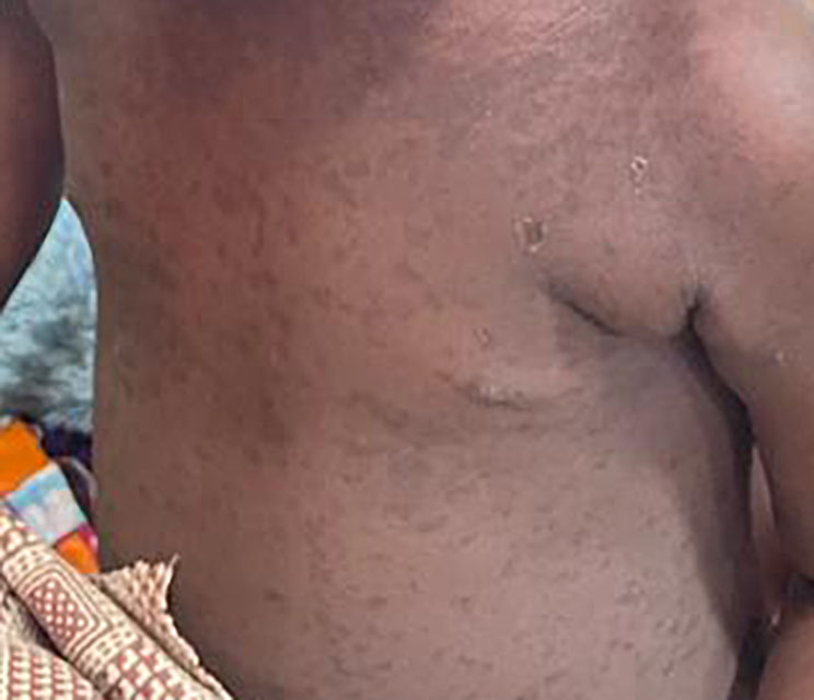 Imagen de sarpullido del sarampión en el torso de un niño con piel más oscura.