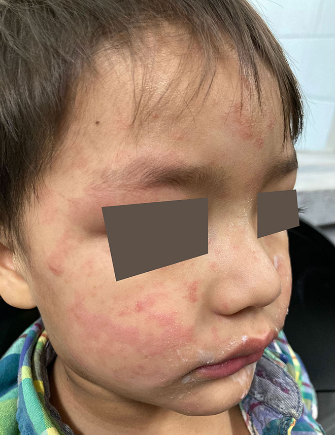 Imagen del sarpullido del sarampión en la cara y las mejillas de un niño.