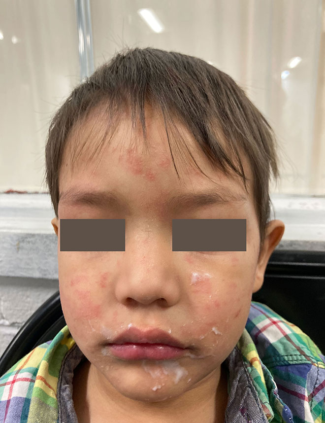 Imagen del sarpullido del sarampión en la cara y las mejillas de un niño.