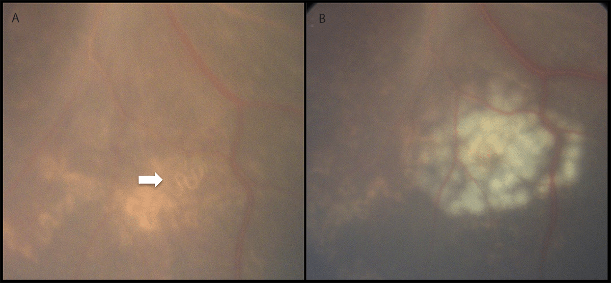 Baylisascariasis (Raccoon Roundworm Infection) in Two Unrelated Children — Los Angeles County, California, 2024 The figure consists of two color images of an eye that illustrate a live subretinal nematode (left) and the treated area of the eye (right) immediately after laser ablation treatment in a patient with diagnosed baylisascariasis .