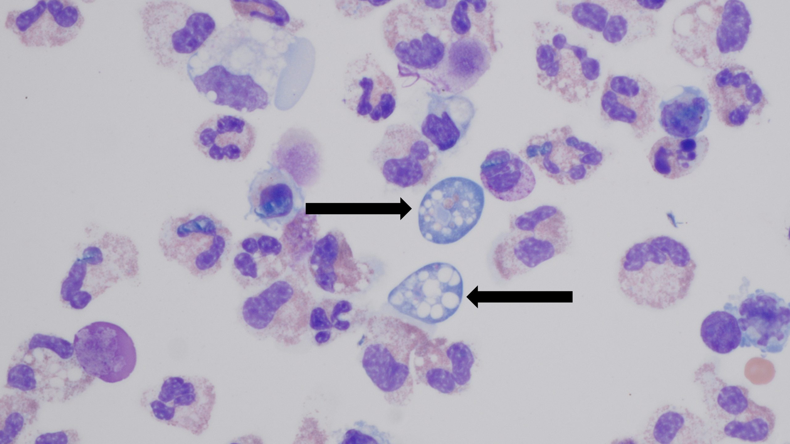 Two arrows point to Naegleria fowleri in the fluid around a person's brain.