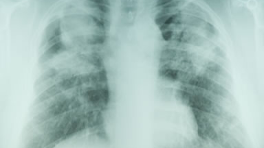 Lung x-ray showing pneumoconiosis in coal miner.