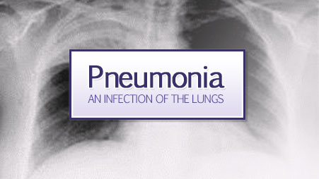 Chest x-ray x-ray of the lungs with pneumonia