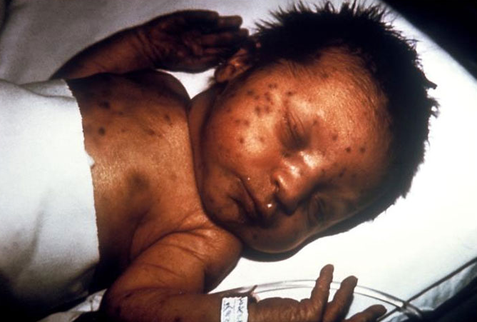 PHIL_713_lores Infant with what is referred to as blueberry muffin skin lesions, which was indicative of congenital rubella.