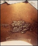 Niño con piel oscura y antecedentes de leucemia con una erupción maculopapular. Esto se diagnoticó como un brote de herpes-zóster debido al patógeno del cirus de la varicela-zóster.