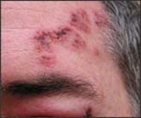 Sarpullido facial y párpados hinchados a causa de la culebrilla en una persona con piel clara.