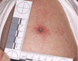An upper arm with a lesion from smallpox vaccination